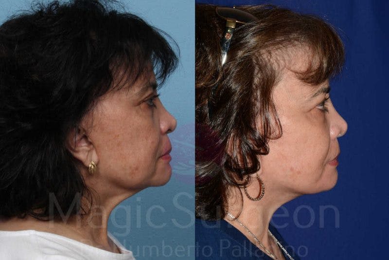 Facelift Before & After Gallery - Patient 133182355 - Image 5