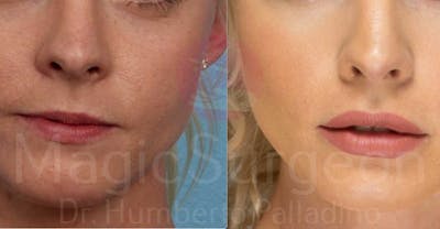 Lip Augmentation Before & After Gallery - Patient 133182356 - Image 1