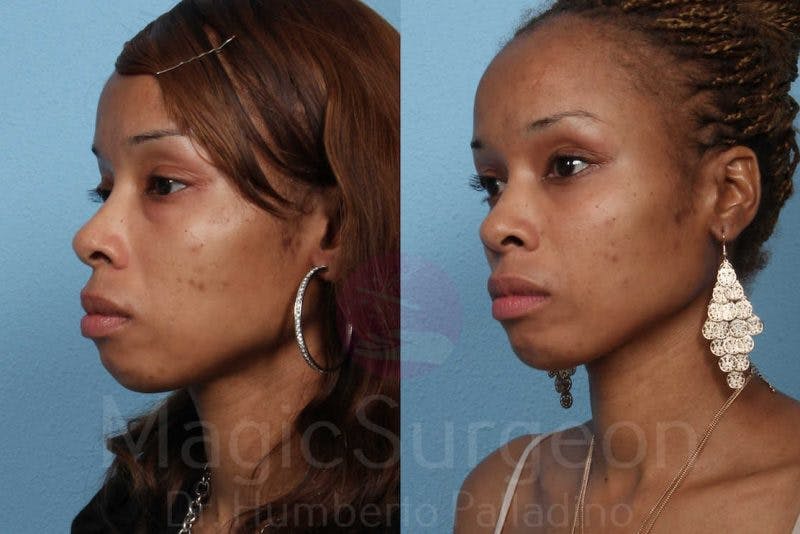 Fat Injections Before & After Gallery - Patient 133182361 - Image 2
