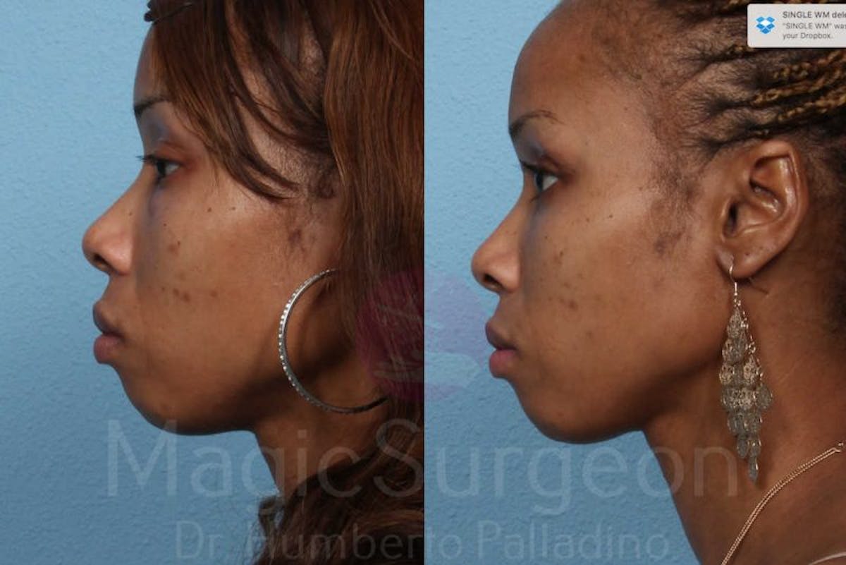 Fat Injections Before & After Gallery - Patient 133182361 - Image 3