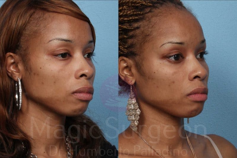 Fat Injections Before & After Gallery - Patient 133182361 - Image 4