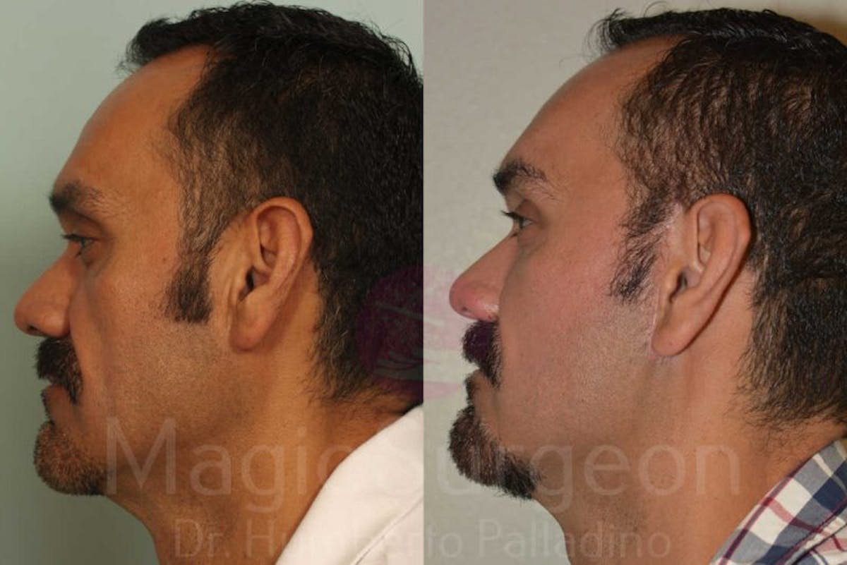 Facelift Before & After Gallery - Patient 133182362 - Image 3