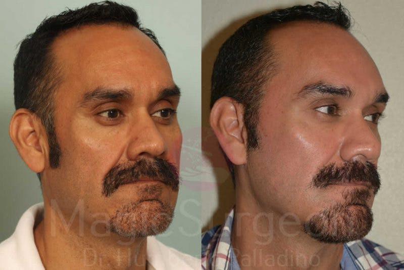 Facelift Before & After Gallery - Patient 133182362 - Image 4