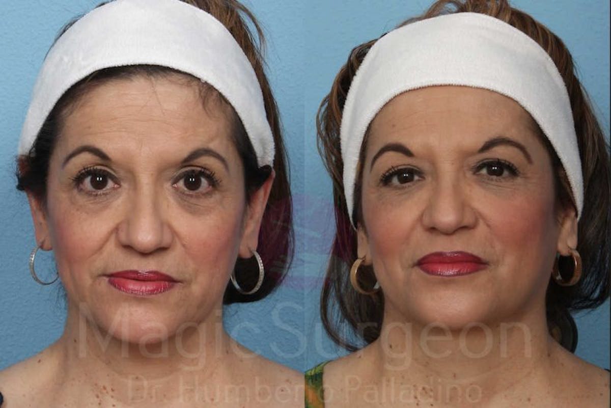 Fat Injections Before & After Gallery - Patient 133182363 - Image 1