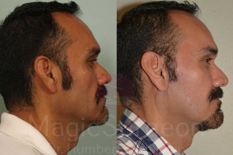 Facelift Before & After Gallery - Patient 133182362 - Image 5