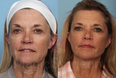 Facelift Before & After Gallery - Patient 133182364 - Image 1