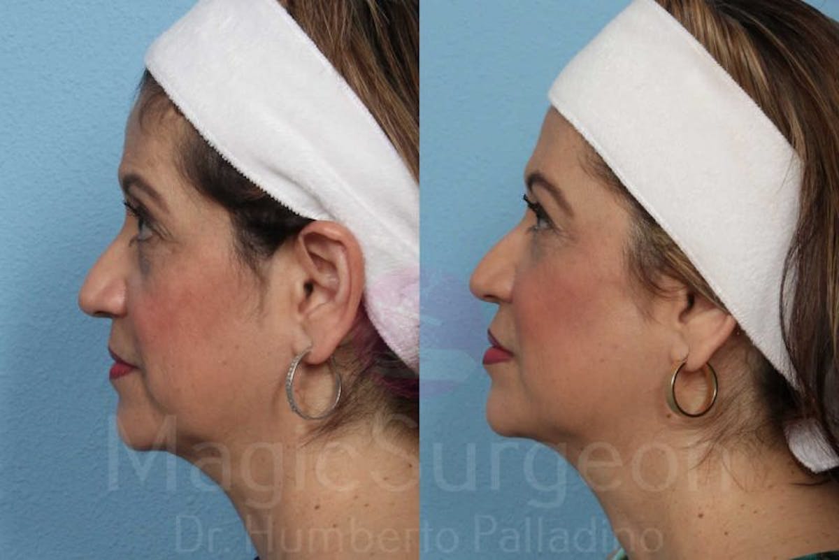 Fat Injections Before & After Gallery - Patient 133182363 - Image 3