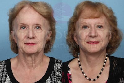 Neck Lift Before & After Gallery - Patient 133182365 - Image 1