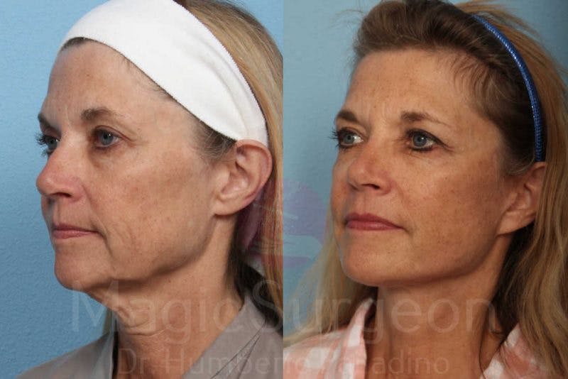 Facelift Before & After Gallery - Patient 133182364 - Image 2