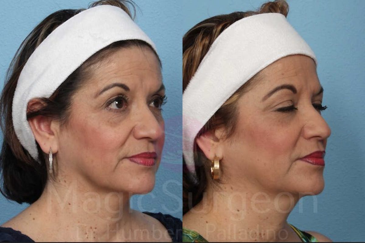 Fat Injections Before & After Gallery - Patient 133182363 - Image 4
