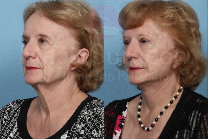 Neck Lift Before & After Gallery - Patient 133182365 - Image 2