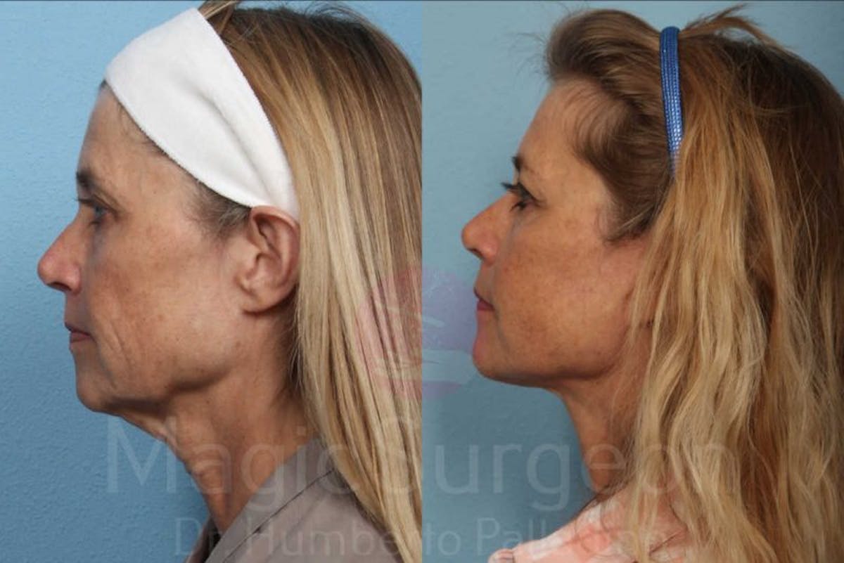Facelift Before & After Gallery - Patient 133182364 - Image 3