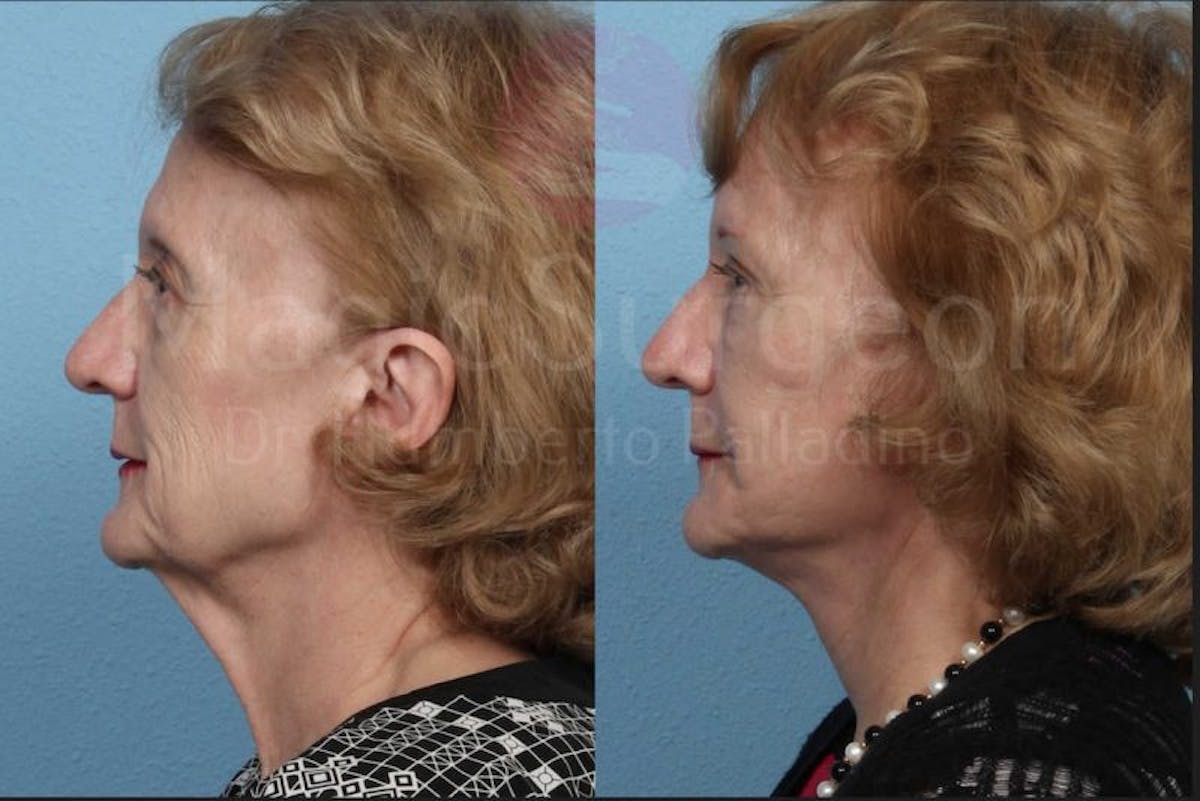 Neck Lift Before & After Gallery - Patient 133182365 - Image 3