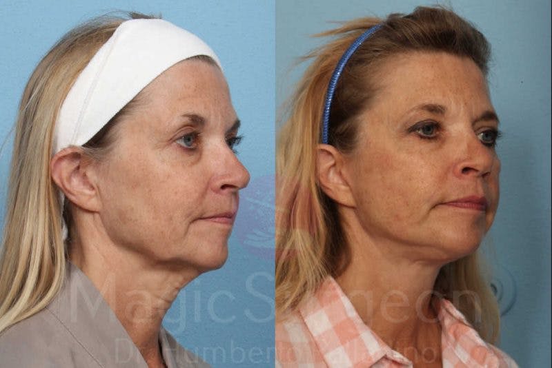 Facelift Before & After Gallery - Patient 133182364 - Image 4