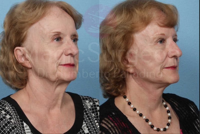 Neck Lift Before & After Gallery - Patient 133182365 - Image 4