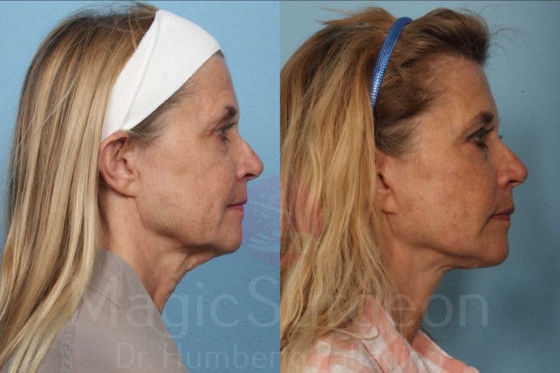 Facelift Before & After Gallery - Patient 133182364 - Image 5