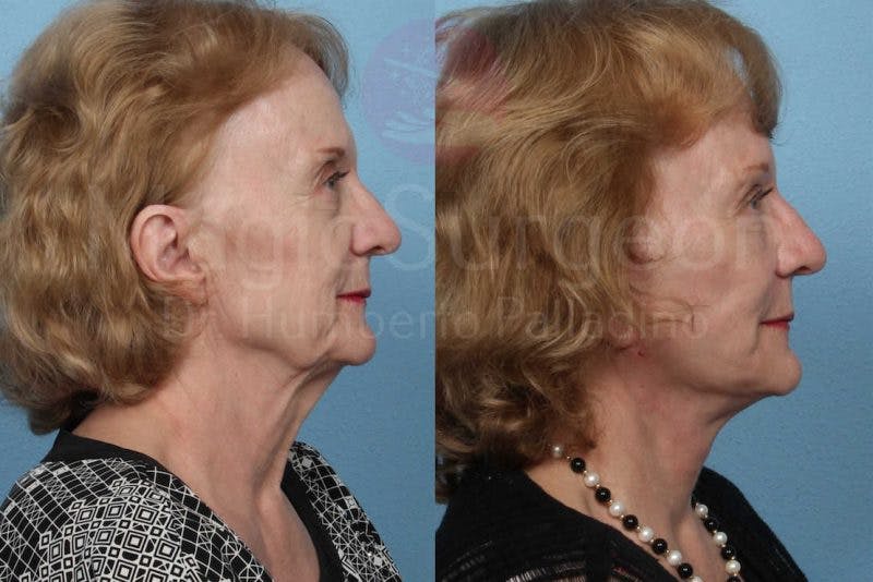 Neck Lift Before & After Gallery - Patient 133182365 - Image 5