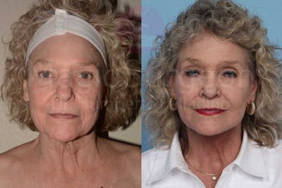 Neck Lift Before & After Gallery - Patient 133182368 - Image 1