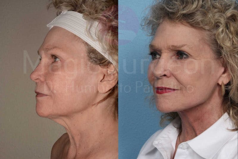 Neck Lift Before & After Gallery - Patient 133182368 - Image 2