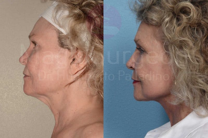Neck Lift Before & After Gallery - Patient 133182368 - Image 3