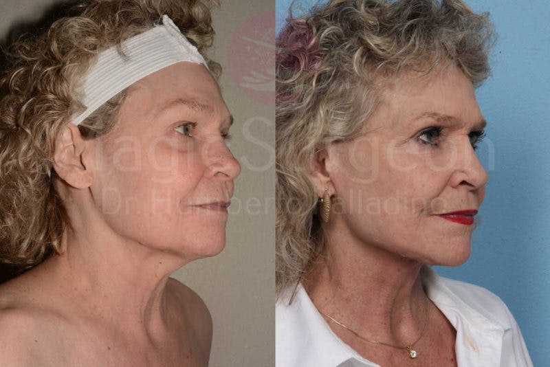 Neck Lift Before & After Gallery - Patient 133182368 - Image 4