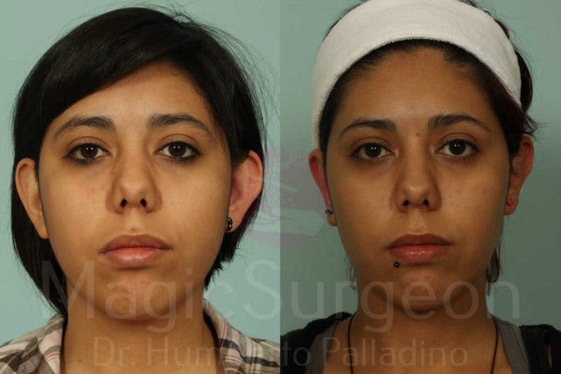 Otoplasty Before & After Gallery - Patient 133182370 - Image 1