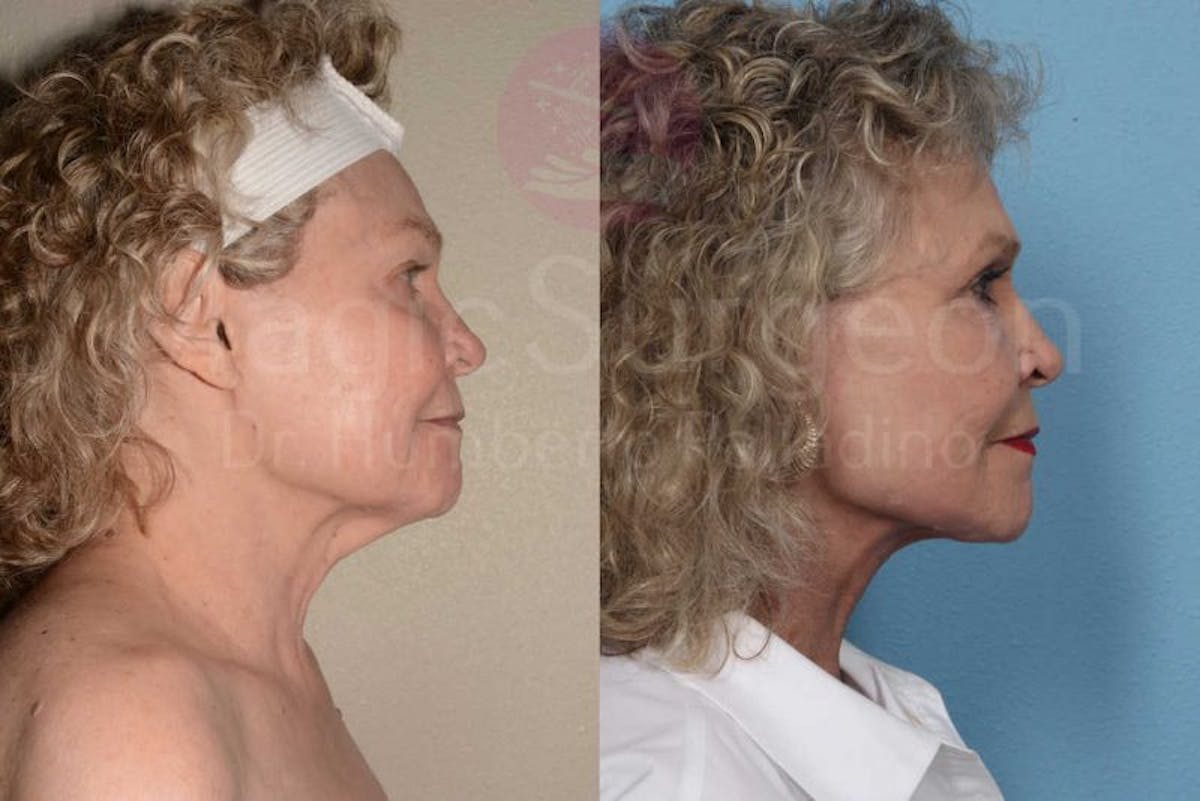 Neck Lift Before & After Gallery - Patient 133182368 - Image 5