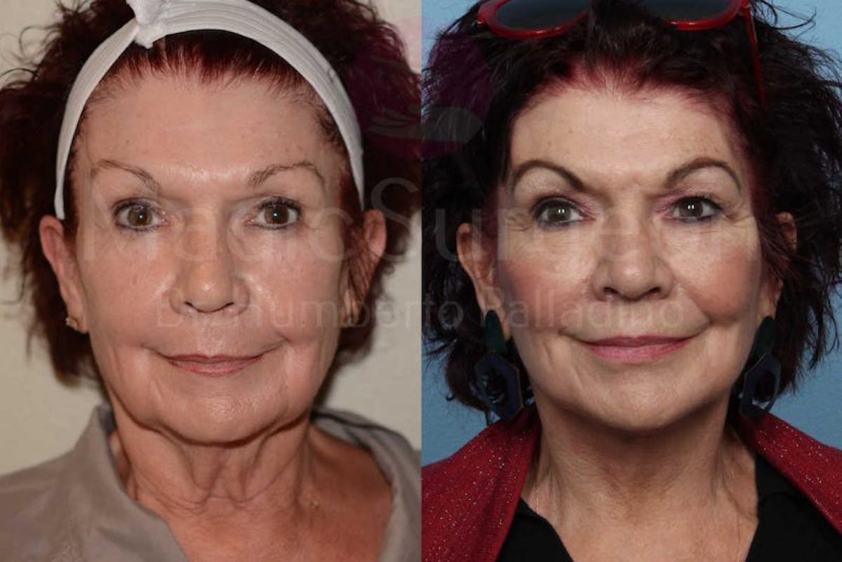 Neck Lift Before & After Gallery - Patient 133182372 - Image 1