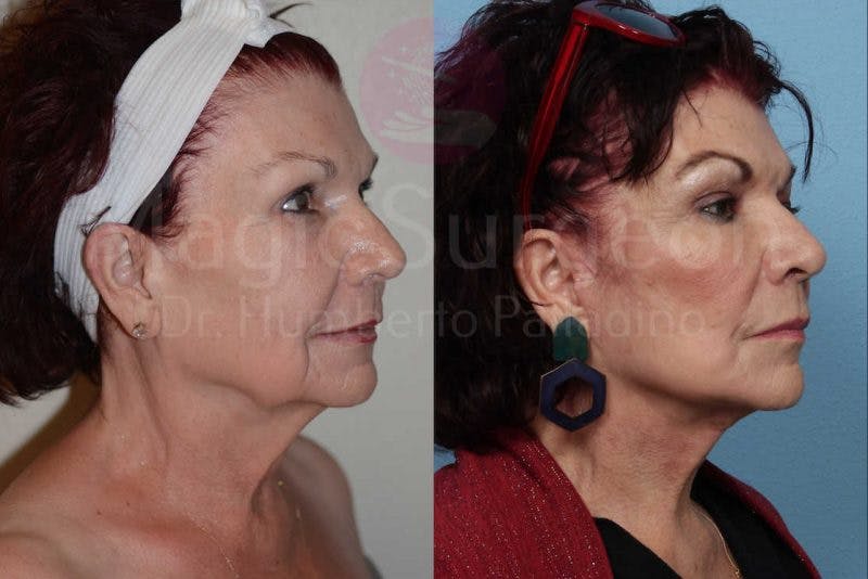 Neck Lift Before & After Gallery - Patient 133182372 - Image 2