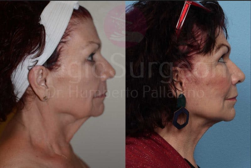 Neck Lift Before & After Gallery - Patient 133182372 - Image 3