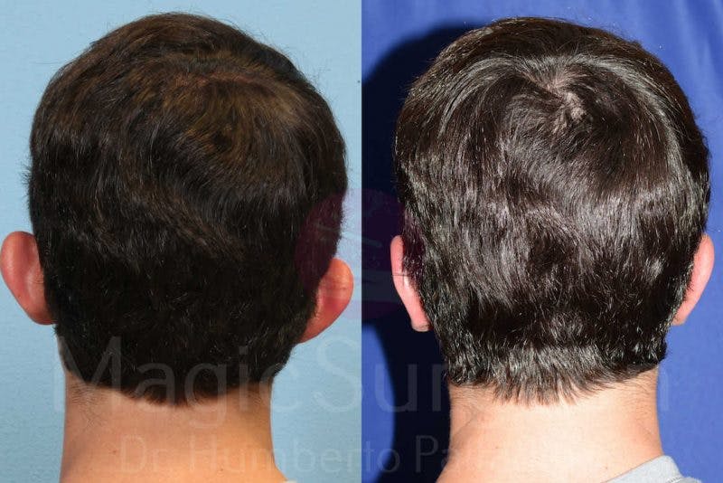 Otoplasty Before & After Gallery - Patient 133182371 - Image 2