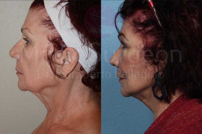 Neck Lift Before & After Gallery - Patient 133182372 - Image 4