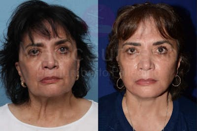 Neck Lift Before & After Gallery - Patient 133182378 - Image 1
