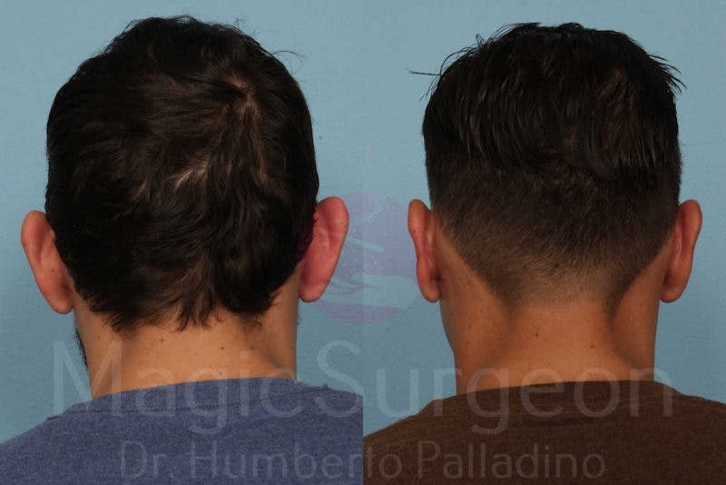 Otoplasty Before & After Gallery - Patient 133182374 - Image 2