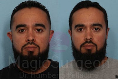 Otoplasty Before & After Gallery - Patient 133182377 - Image 1