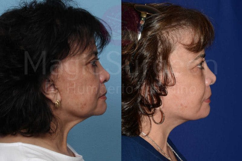 Neck Lift Before & After Gallery - Patient 133182378 - Image 5