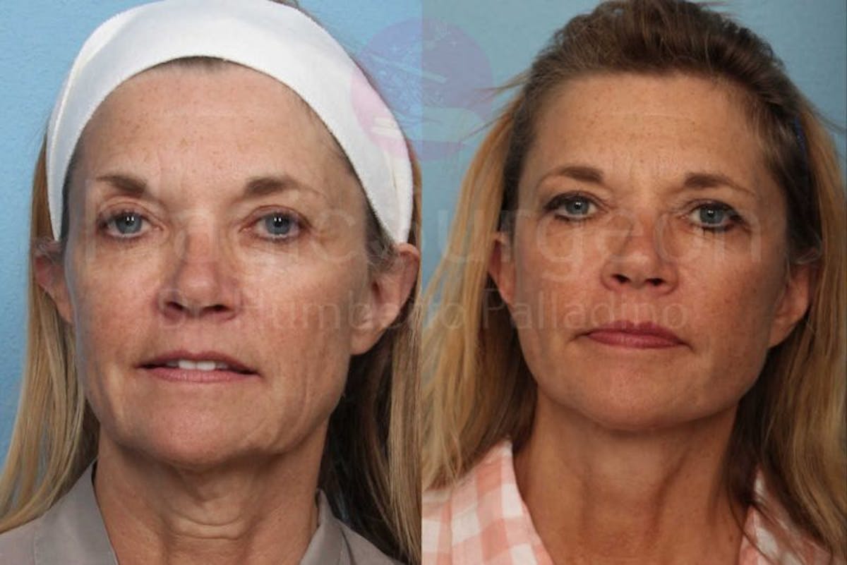 Neck Lift Before & After Gallery - Patient 133182380 - Image 1