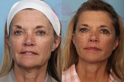 Neck Lift Before & After Gallery - Patient 133182380 - Image 1