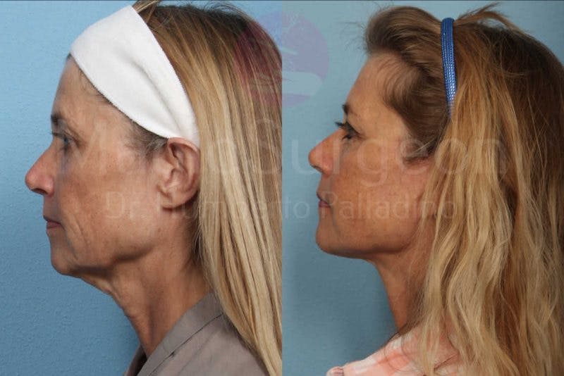 Neck Lift Before & After Gallery - Patient 133182380 - Image 3