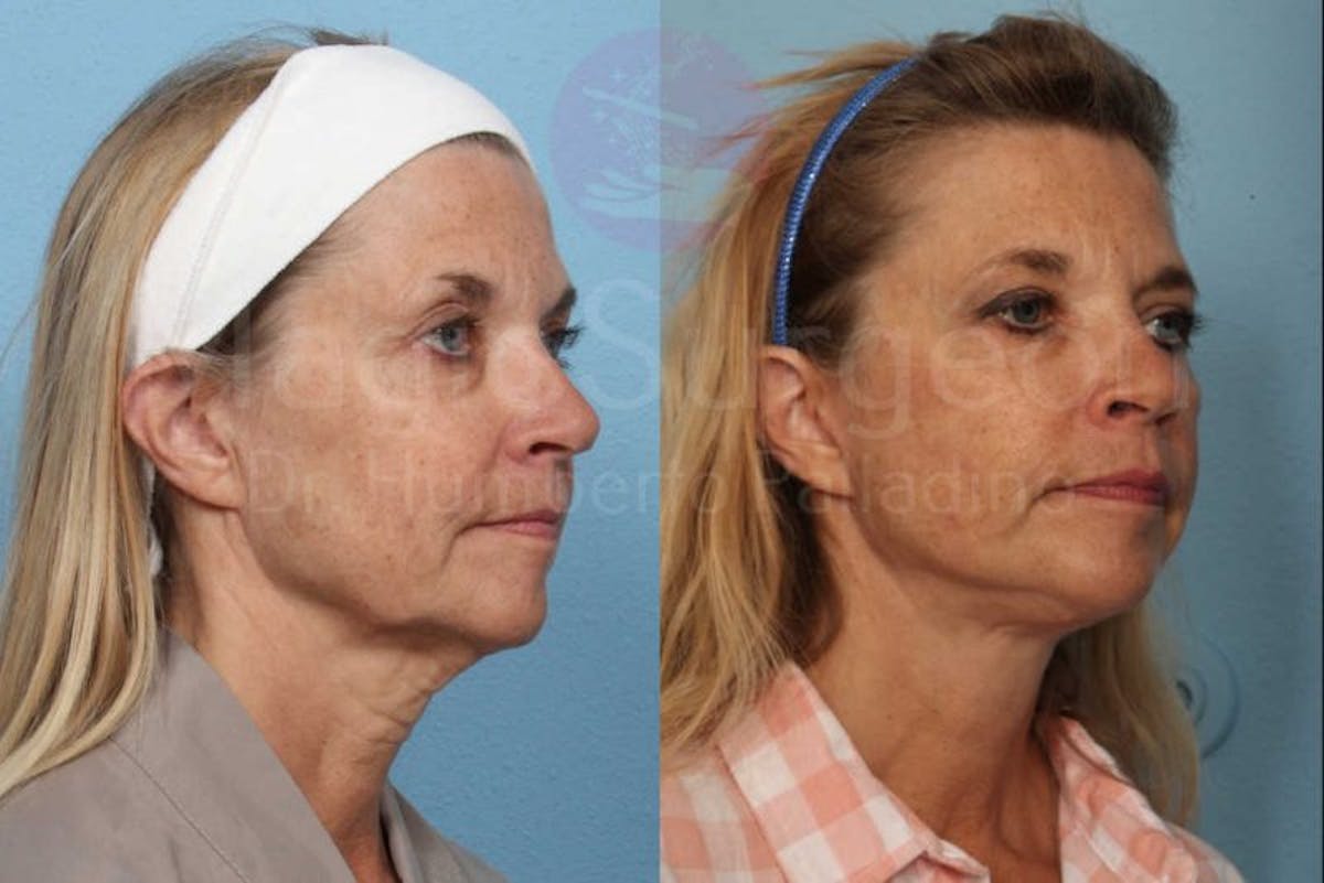 Neck Lift Before & After Gallery - Patient 133182380 - Image 4