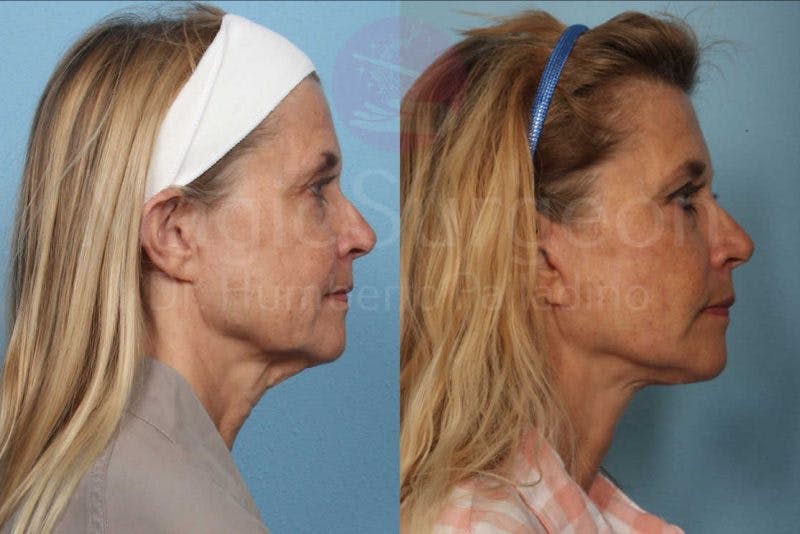 Neck Lift Before & After Gallery - Patient 133182380 - Image 5