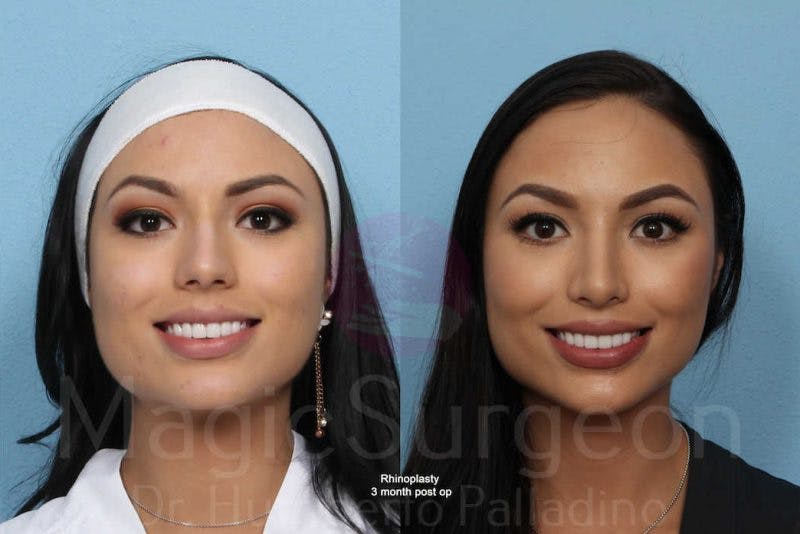 Rhinoplasty Before & After Gallery - Patient 133182401 - Image 1