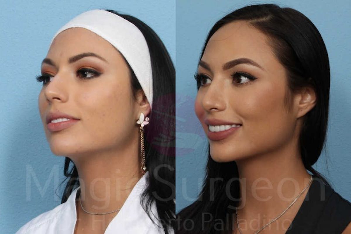 Rhinoplasty Before & After Gallery - Patient 133182401 - Image 2