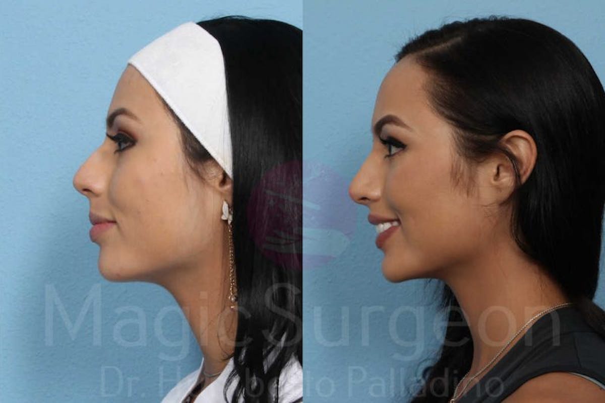 Rhinoplasty Before & After Gallery - Patient 133182401 - Image 3
