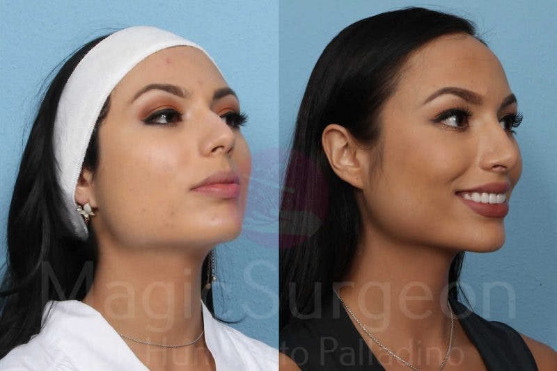 Rhinoplasty Before & After Gallery - Patient 133182401 - Image 4