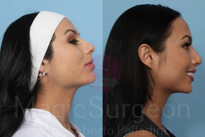 Rhinoplasty Before & After Gallery - Patient 133182401 - Image 5