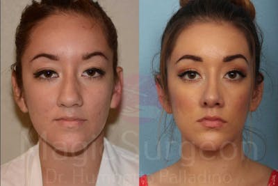 Rhinoplasty Before & After Gallery - Patient 133182403 - Image 1
