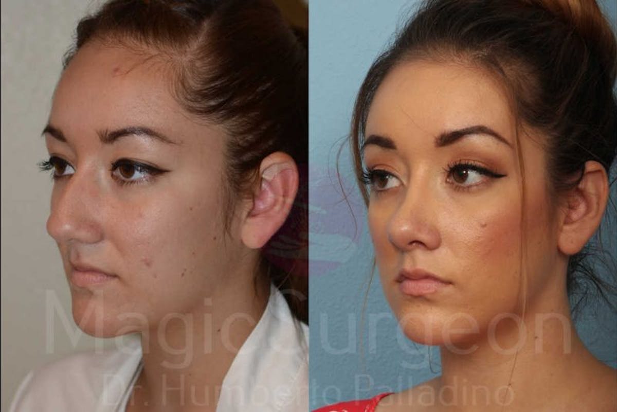 Rhinoplasty Before & After Gallery - Patient 133182403 - Image 2