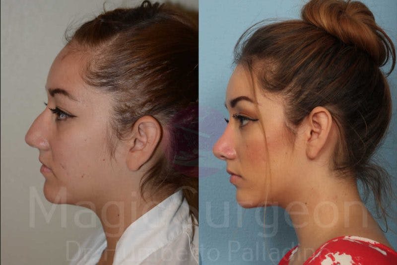 Rhinoplasty Before & After Gallery - Patient 133182403 - Image 3