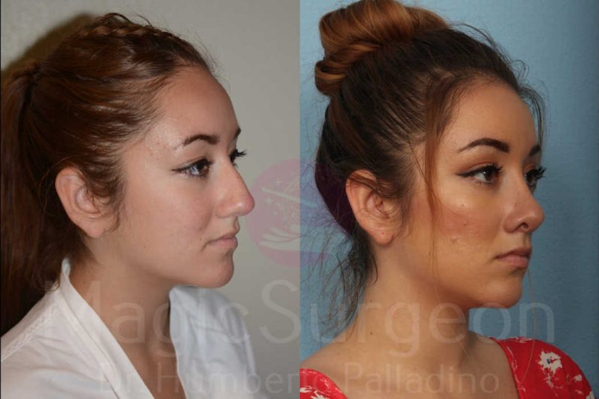 Rhinoplasty Before & After Gallery - Patient 133182403 - Image 4